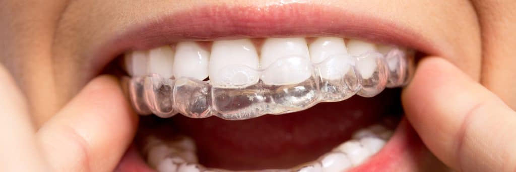 How Does Invisalign Work?