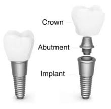 Implant diagram